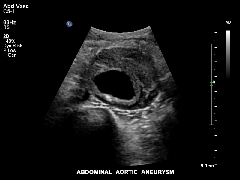 Аневризма брюшной аорты, С5-1