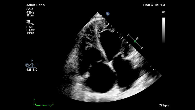 Эхокардиография, S5-1