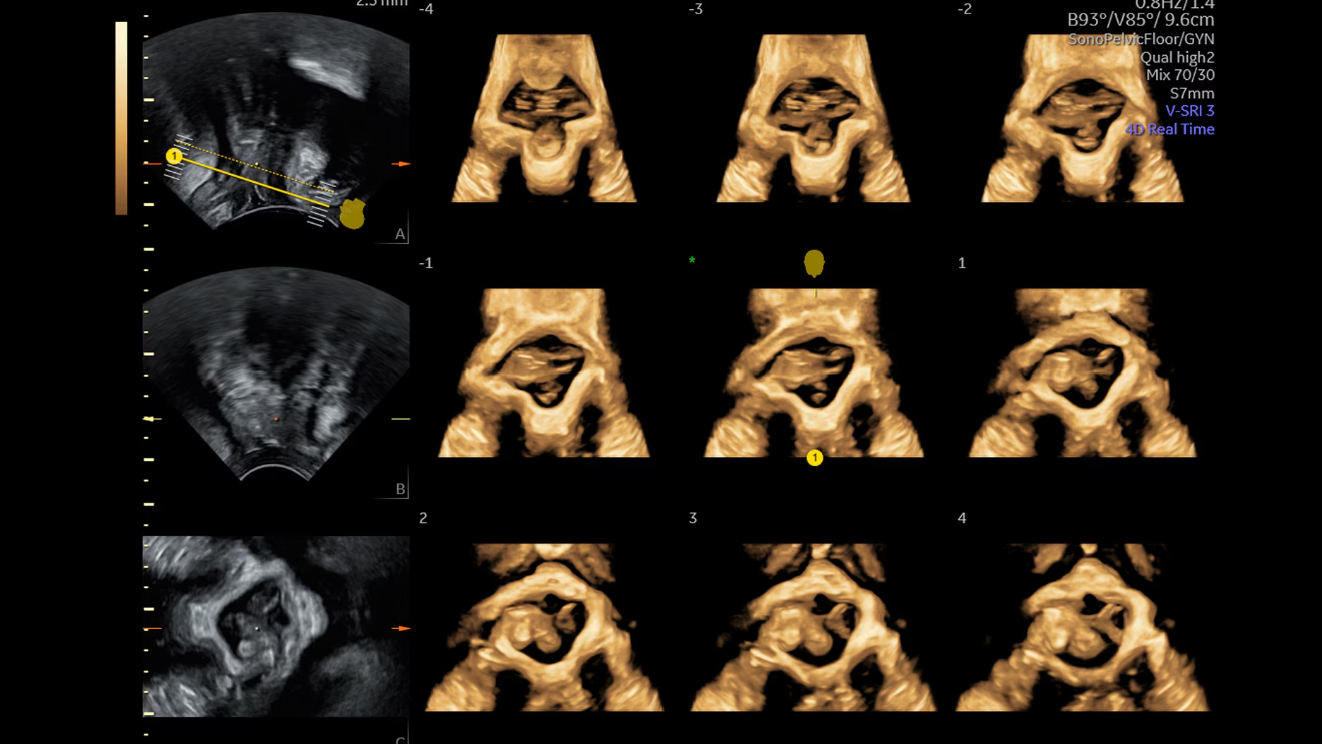 Серийные плоскости анатомии тазового дна, продемонстрированные с помощью SonoPelvicFloor, управляемого искусственным интеллектом