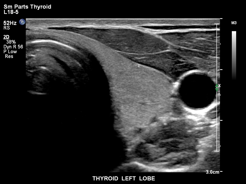 Щитовидная железа, левая доля, L18-5