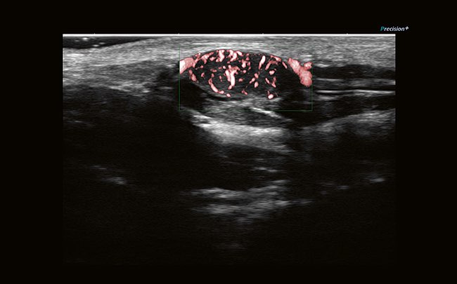 Технология Superb Micro-vascular Imaging в сочетании с высокой частотой кадров повышает диагностическую достоверность при оценке микроциркуляторного русла за счет отображения низкоскоростного кровотока в микрососудах. Кроме того, данная технология незамен