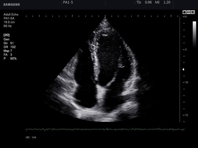 Четырех камерная проекция сердечной мышцы в В-режиме