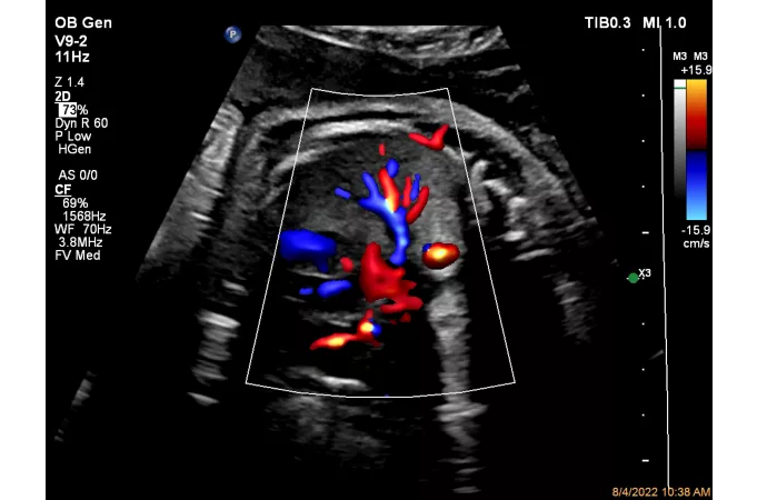 ЦДК перфузии легких плода с Flow Viewer