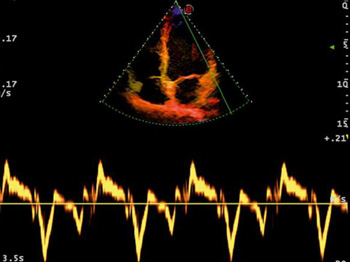 Тканевый доплер. Данная функция подарит вам возможность оценить сократительную способность миокарда. Как правило, она применяется вместе с импульсно-волновым доплером и помогает при проведении диагностики системных поражений сердца, кардомиопатии, ишемии