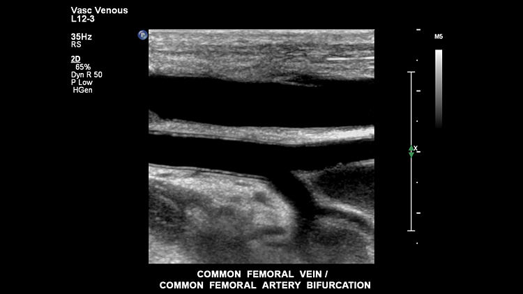 Общая бедренная вена, общие бифуркации бедренной артерии, L12-3