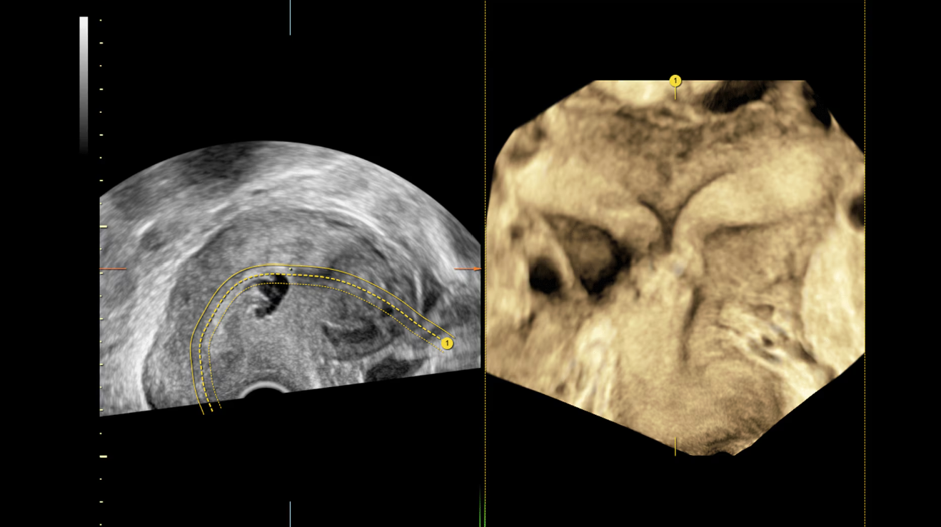 Матка с перегородкой, визуализированная с помощью Uterine Trace