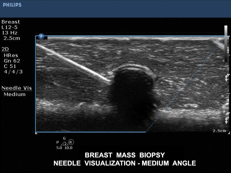 Визуализация иглы при биопсии молочной железы, датчик L12-5