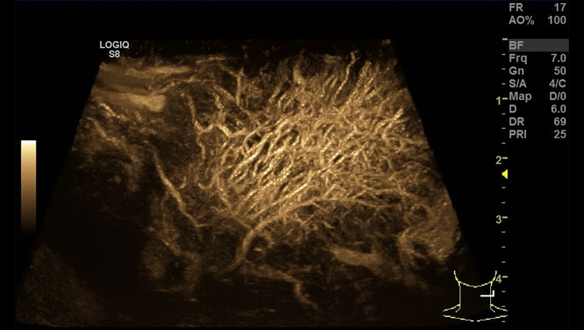 Сосудистая сеть шейного лимфоузла, УЗИ с контрастами (CEUS) + B-FLOW, датчик 9L-D