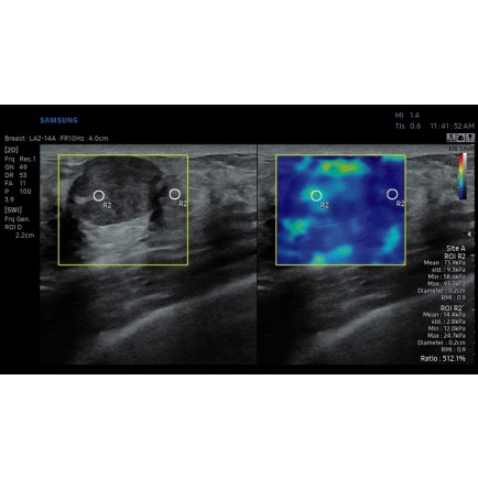 Новообразование молочной железы в режиме S-Shearwave Imaging (эластография сдвиговой волной), линейный датчик 2-14 МГц