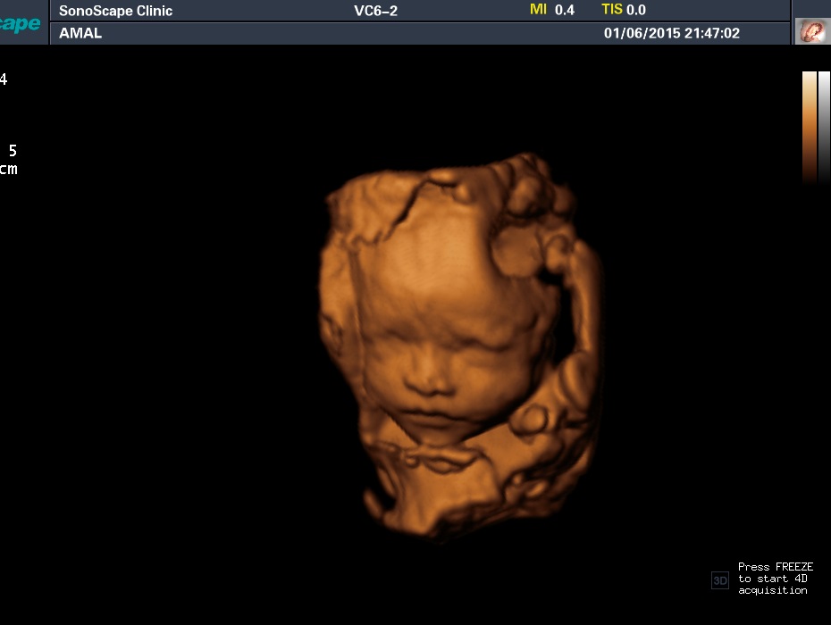 Лицо плода, 3D