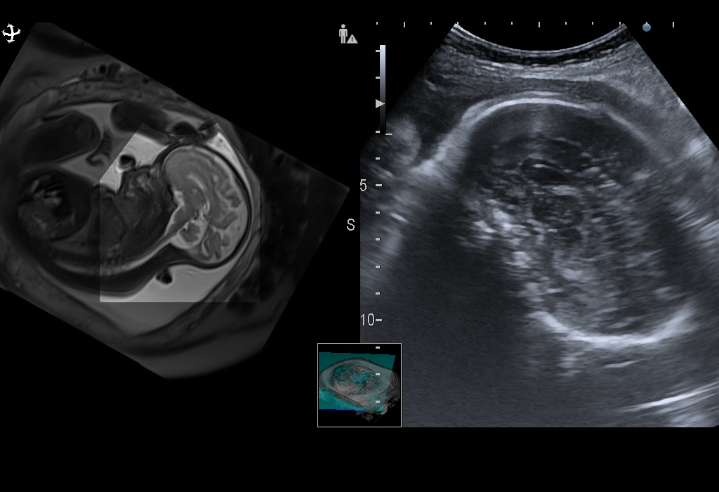 Головной мозг плода. Синхронная мультимодальная визуализация с помощью технологии Real-time Virtual Sonography (RVS) позволяет комплексно оценить головной мозг плода