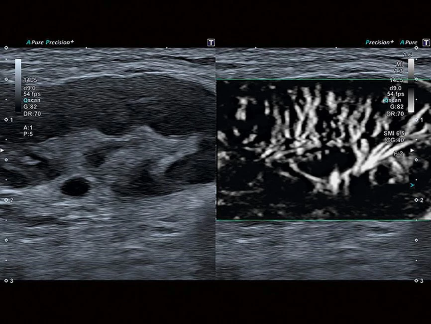 Уровень сосудистой визуализации SMI в сочетании с высокой частотой кадров повышает диагностическую достоверность при оценке поражений, кист и опухолей.