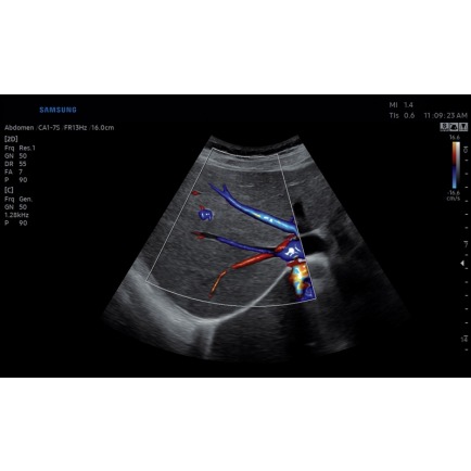 Печень в режиме MV-Flow и LumiFlow, конвексный датчик 1-7 МГц