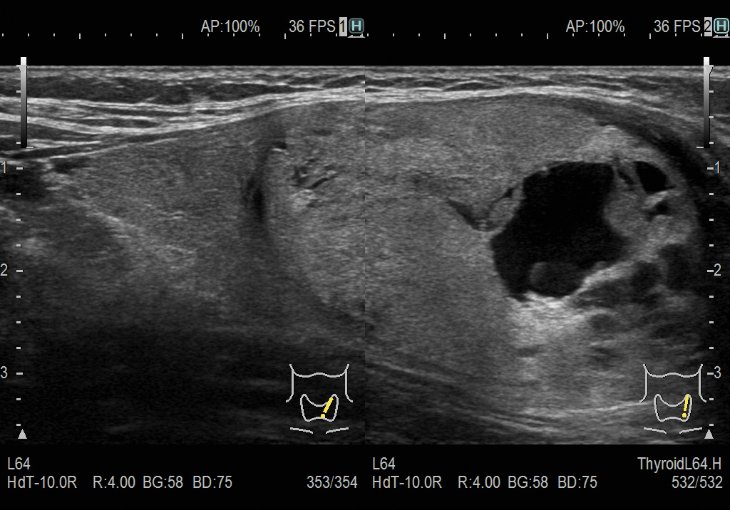 Образование в щитовидной железе. Визуализация на двойном экране в режиме eFocusing