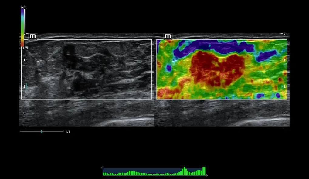 Эластография опухоли молочной железы