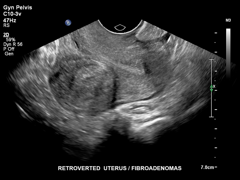 Ретровертированная матка, C10-3v