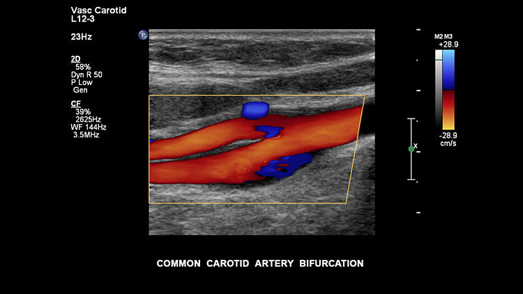 Бифуркация общей сонной артерии, L12-3