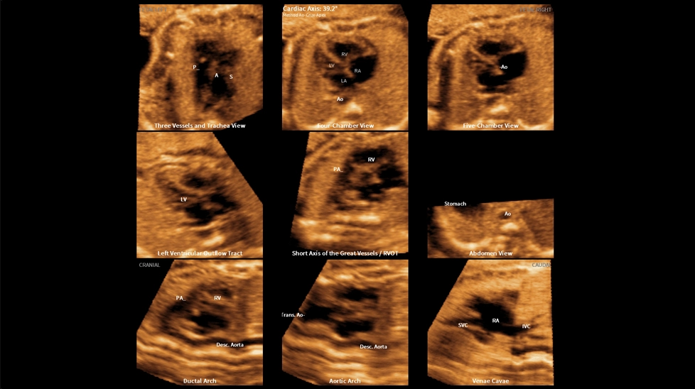 9 стандартных видов сердца плода с 5D Heart Color