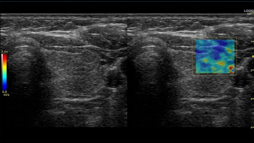 Щитовидная железа, 2D-эластография сдвиговой волны