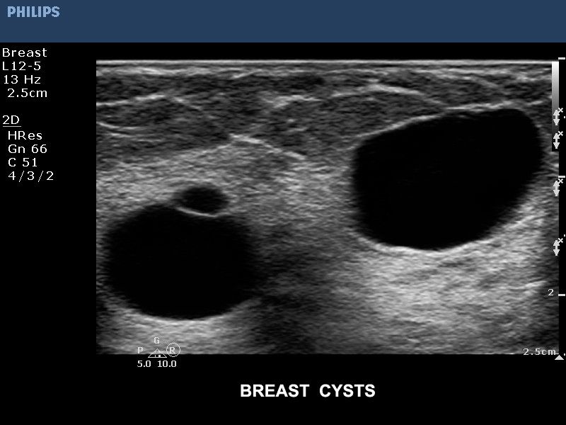 Киста молочной железы, датчик L12-5
