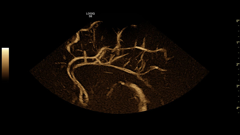 Мозг новорожденного в режиме B-FLOW, датчик 10C-D