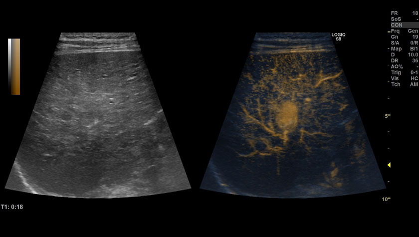 Печень, УЗИ с контрастами (CEUS), датчик 9L-D