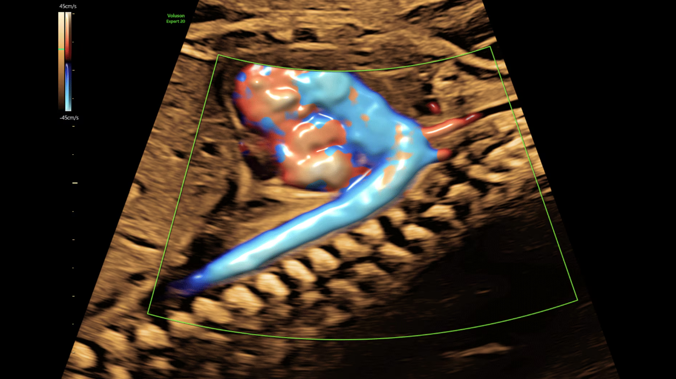 Дуга аорты, показанная с помощью Radianflow у плода на 26 неделе беременности
