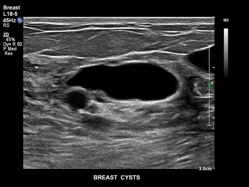 Кисты молочной железы, L18-5
