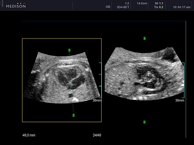 Сердце плода- косой срез, В-режим