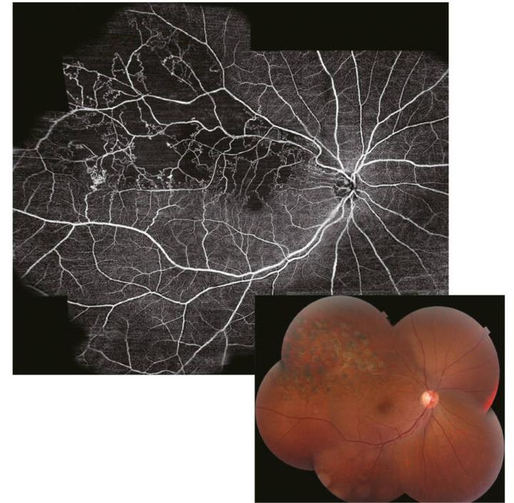 branch-retinal-vein-occlusion.jpg